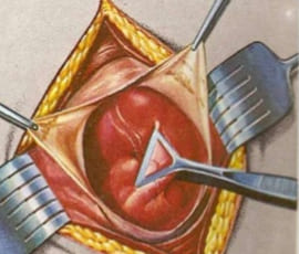 Apendicetomía abierta 